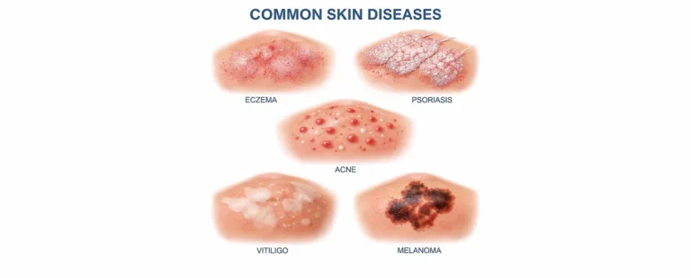 Skin Disease