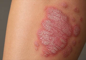 Psoriasis